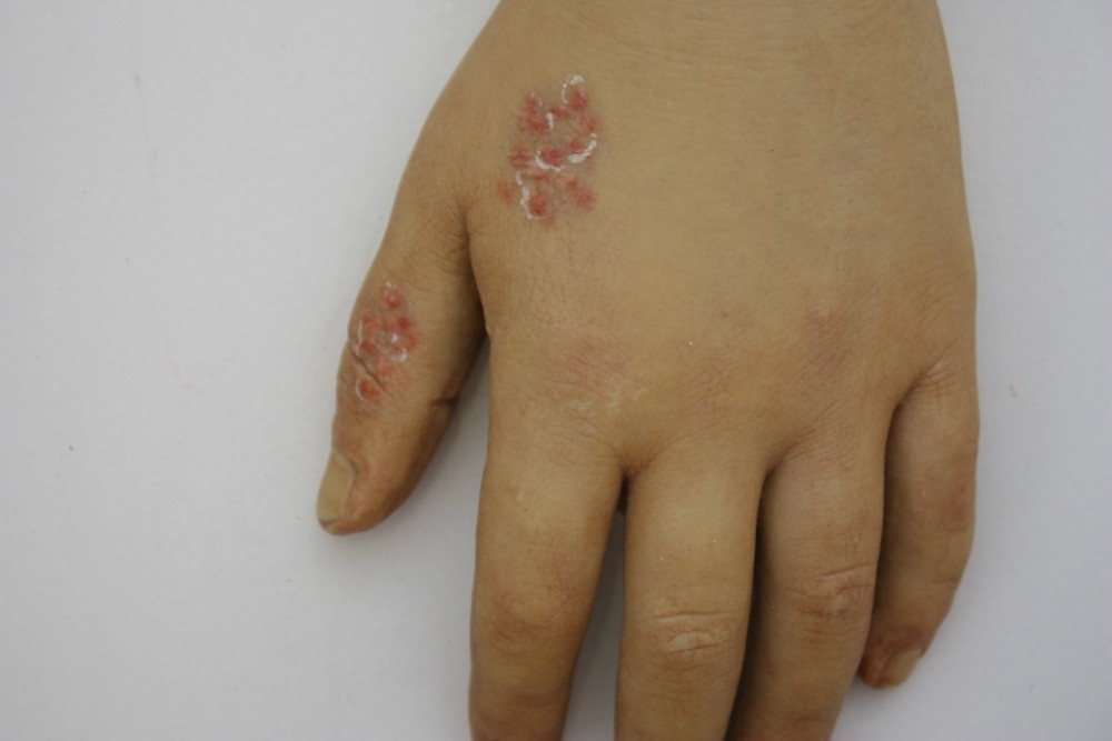 Moulage, Tuberculosis cutis verrucosa (Hand/Finger), 34x26 cm