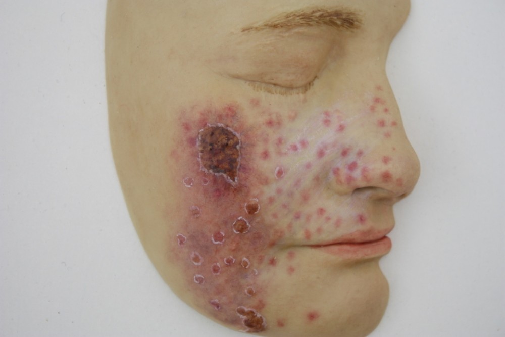 DermIS - Lupus Vulgaris (information on the diagnosis)