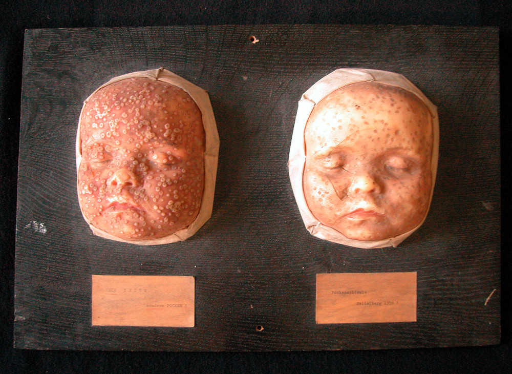Moulage, Pocken auf zwei Gesichtern · Universitätssammlungen in Deutschland