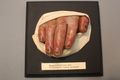 Moulage, Nagelaffektion bei Pityriasis rubra pilaris (Fingernägel), 17x17 cm