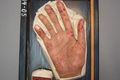 Moulage, Oslersche Krankheit (Hand/Zunge) [Kaltschmidt], 28x19 cm