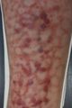 Moulage, Lichen ruber planus (Arm/Bein) [Kaltschmidt], 43x19 cm