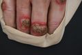 Moulage, Tuberculosis verrucosa cutis (Hand) [G. S.], 25x17,5 cm