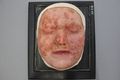 Moulage, Syphilis II (Gesicht) [Kaltschmidt], 27,5x23,5 cm