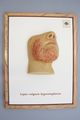 Moulage, Lupus vulgaris hypertrophicus (Gesicht), 34x26 cm