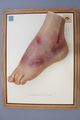 Moulage, Tuberculosis fistulae et ulcera (Fuß), 33,5x25,5 cm