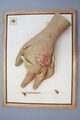 Moulage, Serophuloderma ulcerosum (Hand), 34x26 cm
