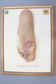 Moulage, Tuberculosis cutis verrucosa (Fußsohle), 34x25,5 cm