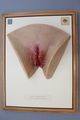 Moulage, Lues I Primäraffekt, Papulae madidantes (weibliche Genitalien), 34x25,5 cm