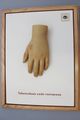 Moulage, Tuberculosis cutis verrucosa (Hand/Finger), 34x26 cm