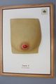Moulage, Lues I Primäraffekt (weibliche Brustwarze), 34x26 cm
