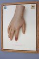 Moulage, Panaritium beginnend (Hand/Zeigefinger), 33,5x25,5 cm