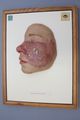 Moulage, Erysipelas bullosum (Gesicht), 33x25,5 cm
