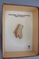 Moulage, Tuberkulöse Knochenauftreibung - Spina Ventosa (Hand/Zeigefinger), 30x21 cm