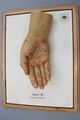 Moulage, Lues II papulöses Syphilid (Handfläche/Finger), 34x25 cm