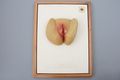 Moulage, Lues I Primäraffekt, Papulae madidantes (weibliche Genitalien/After), 34x26 cm