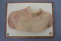 Moulage, Herpes Zoster (Oberarm/Schulter/Hals), 33,5x45 cm