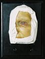Moulage, Ulcus serpens progressivum (linke Gesichtshälfte), 17x23x6 cm