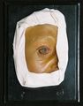 Moulage, Conjunctivitis vernalis, Veränderungen im Limbus (rechte Augenregion), 15,5x21x5 cm
