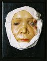 Moulage, Keratitis interstitialis (Gesicht), 17,6 x 23 x 7 cm