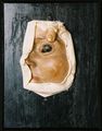 Moulage, Haemangiom der Conjunctiva bulbi (linke Gesichtshälfte/Auge), 18x23,5x5 cm
