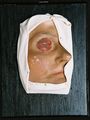 Moulage, Chalazion (rechte Gesichtshälfte/Auge), 18x23,5x4 cm