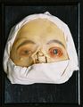 Moulage, Conjunctivitis gonorrh. adultor. (Augen), 17,5x23x10 cm