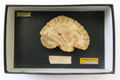 Moulage, Stauungsblutungen im Gehirn (purpura cerebri) nach Phosgenvergiftung [Kolbow], 19,5x30,5x9,5 cm