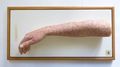 Moulage, Eccema Endogenes (rechter Arm bis Ellenbogen)
