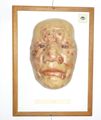 Moulage, Lepra (Gesicht frontal)