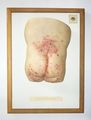 Moulage, Eccema intertriginosum (Gesäß mit Rückenansatz)