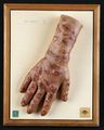 Moulage, Lepra Tuberosa (rechte Hand mit Handgelenk)
