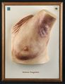 Moulage, Mykosis fungoides (linker oberer Torso mit Armansatz, Achselbereich)