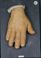 Moulage, Akromegalie bei Syphilis (Hand) [Henning]