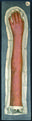 Moulage, Pityriasis rubra (Arm)