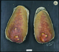 Moulage, Dermatitis atrophicans idiopathica progressiva diffusa (Ellenbögen) [Henning]