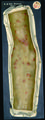 Moulage, Syphilis II, papulopustulosa (Arm) [Bois-Reymond]