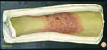 Moulage, Syphilis III, gummosa cruris dextris (Bein) [Leonhardt]