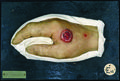 Moulage, Epithelioma papillomatosum manus dextrae (Hand) [Leonhardt]