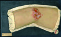 Moulage, Syphilis III, gummata ulcerosa cutis (Ellenbogen) [Leonhardt]