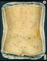 Moulage, Syphilis II, papulopustulosa (Rücken/Gesäß) [Leonhardt]