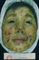 Moulage, Lepra tuberosa (Gesicht frontal) [Kasten]